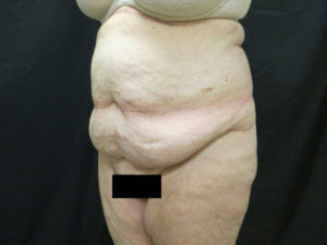 Tummy Tuck Before and After Images in Ventura, CA