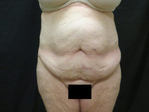 Tummy Tuck Before and After Images in Ventura, CA