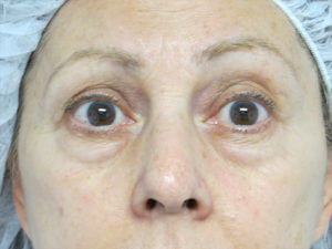 Upper and Lower Blepharoplasty Before and After Pictures in Ventura, CA