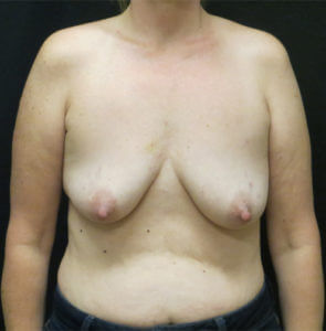 Breast Lift Before and After Pictures in Ventura, CA