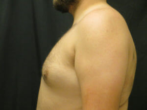 Gynecomastia Before and After Pictures in Ventura, CA
