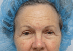 Upper and Lower Blepharoplasty Before and After Pictures in Ventura, CA