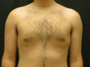Gynecomastia Before and After Pictures in Ventura, CA