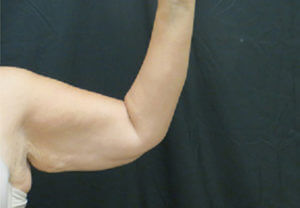 Arm Lift Before and After Pictures in Ventura, CA