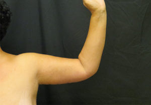 Arm Lift Before and After Pictures in Ventura, CA