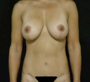 Breast Lift Before and After Pictures in Ventura, CA