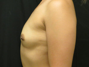 Breast Augmentation Before and After Pictures in Ventura, CA