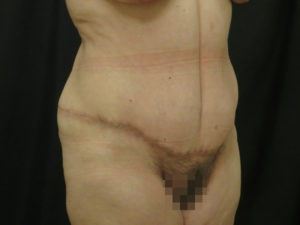 Tummy Tuck Before and After Pictures in Ventura, CA