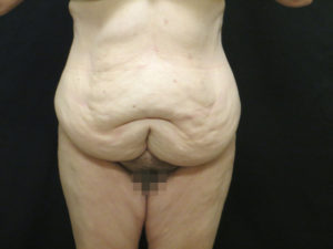 Tummy Tuck Before and After Pictures in Ventura, CA