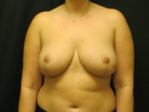 Breast Reduction Before and After Pictures in Ventura, CA