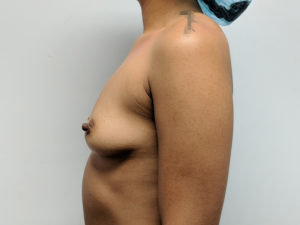 Breast Augmentation Before and After Pictures in Ventura, CA