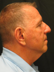 Neck Lift Before and After Pictures in Ventura, CA