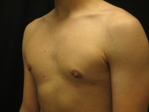 Gynecomastia Before and After Pictures Ventura, CA