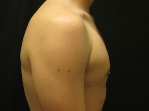 Gynecomastia Before and After Pictures Ventura, CA